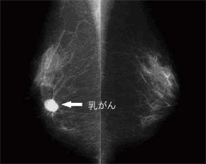マンモグラフィ画像