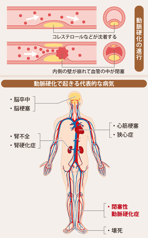 動脈硬化の進行