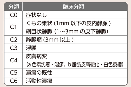下肢静脈瘤の症状