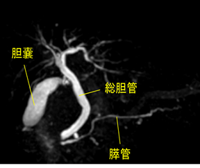 【MRCP検査画像】