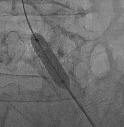 足のステント治療中