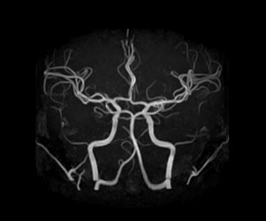 頭部MRA