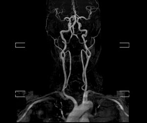 頭頸部MRA