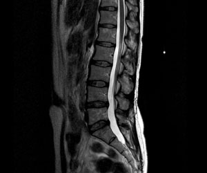 腰椎MRI