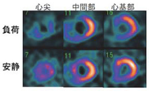 心筋シンチ