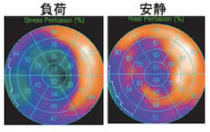 心筋シンチ