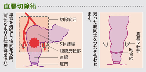 直腸切除術