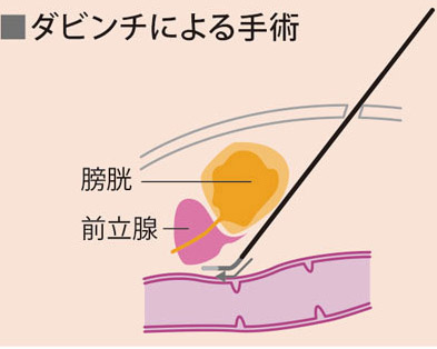 ダビンチによる手術