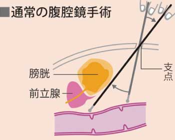 通常の腹腔鏡