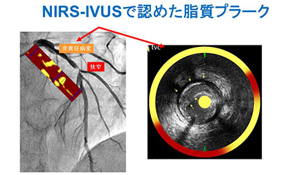 IVUS