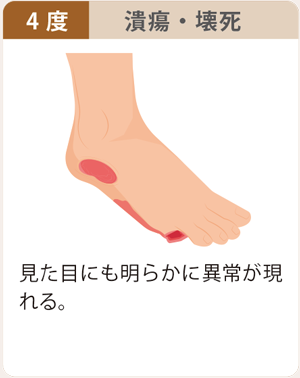 下肢閉塞性動脈硬化症症状4