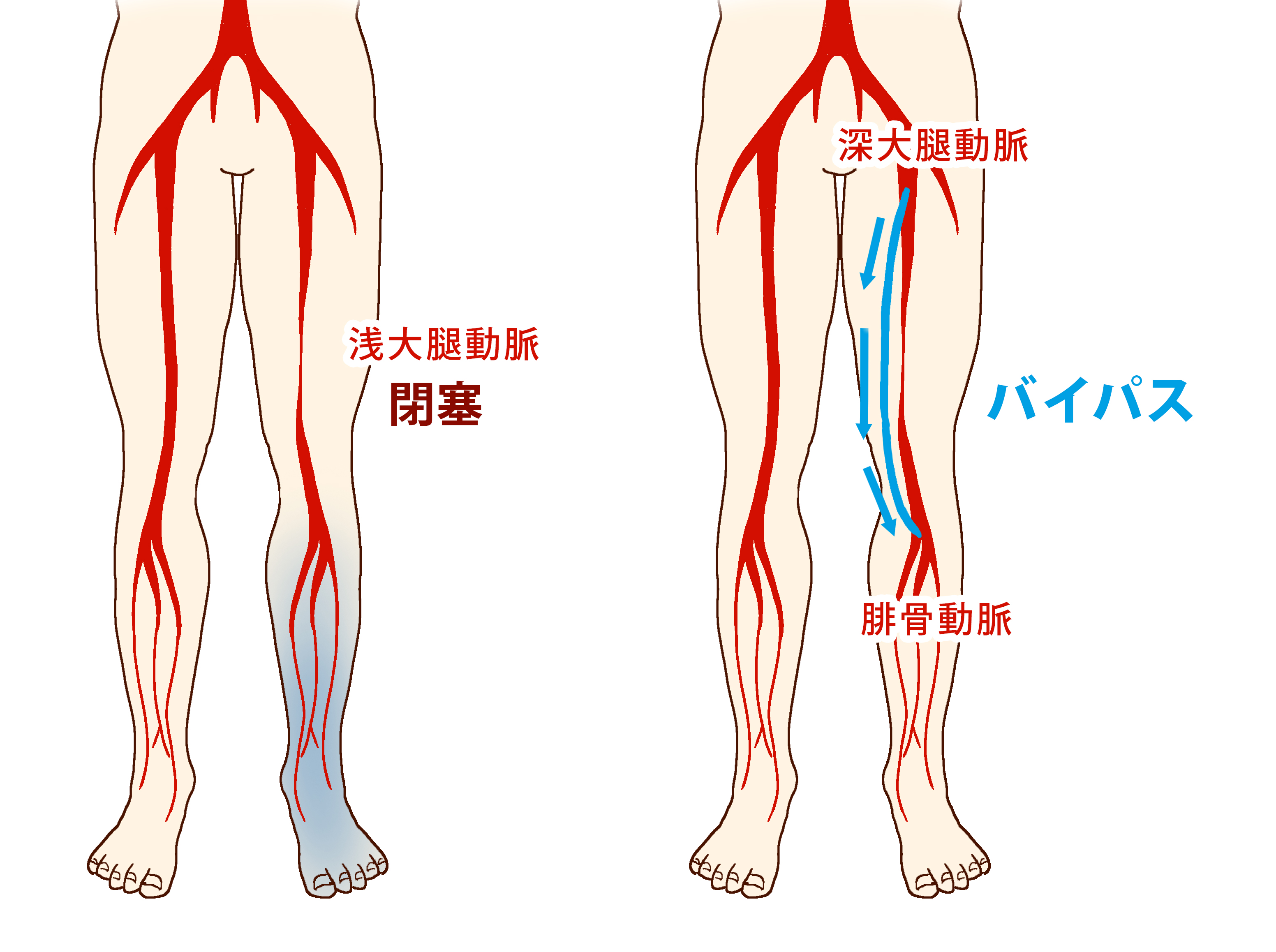 下肢閉塞性動脈硬化症バイパスイメージ