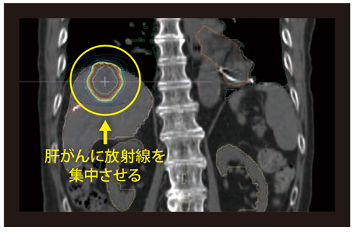 linac